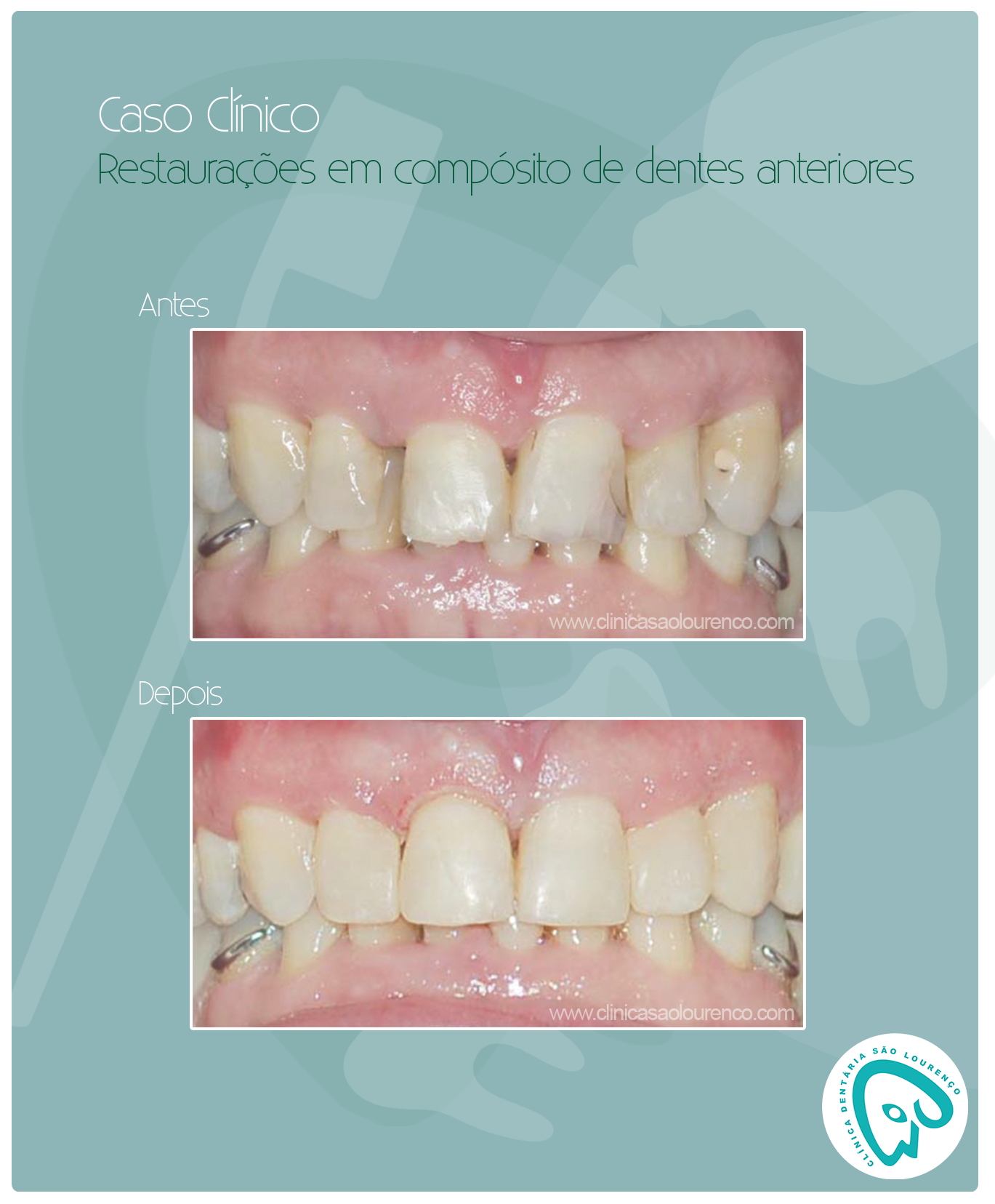 Restaurações em compósito de dentes anteriores