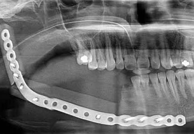 ameloblastoma depois1 1