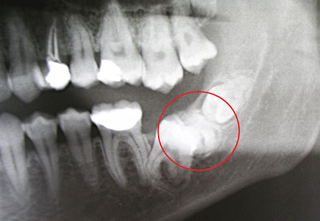 odontoma